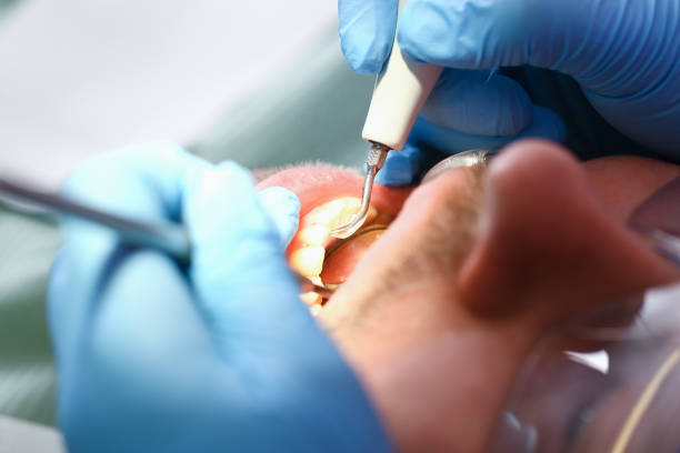 Best Emergency Tooth Extraction in Rkside, PA
